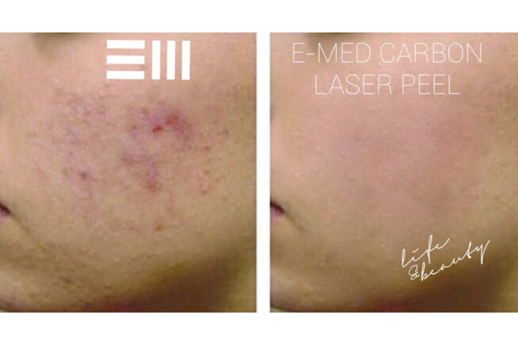 carbon peel (5)