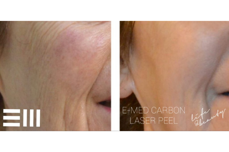 carbon peel (6)